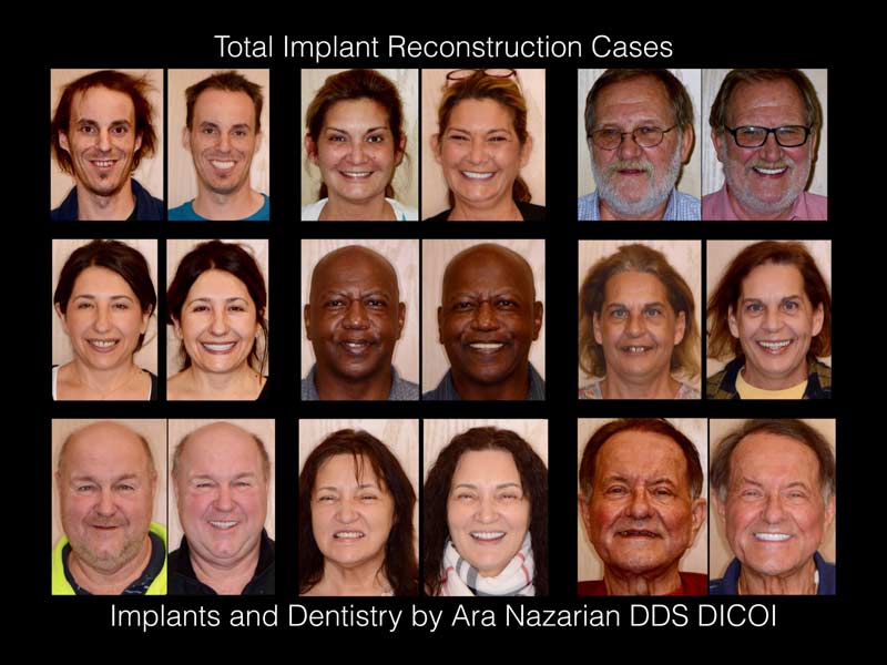all-on-4-dental-implants-results-shelby-township-mi all on 4 dental implants results Shelby Township mi