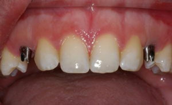 Dental Implant Dentist Shelby Township MI Dental Implant Dentist Shelby Township MI