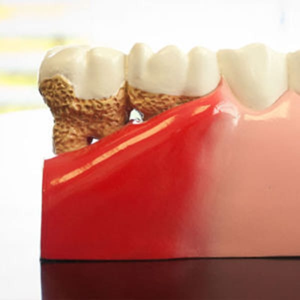 Dental Implant Dentist Shelby Township Dental Implant Dentist Shelby Township