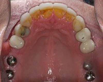 Dental Implant Surgery Dentist Shelby Township MI Dental Implant Surgery Dentist Shelby Township MI