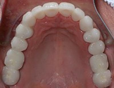 Dental Implant Surgery Dentist Shelby Township MI Dental Implant Surgery Dentist Shelby Township MI