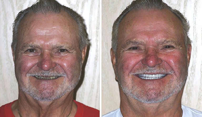 Dental Implants Dentist Near Me