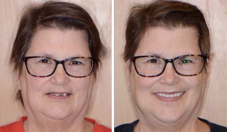 Full Mouth Reconstruction Dentist