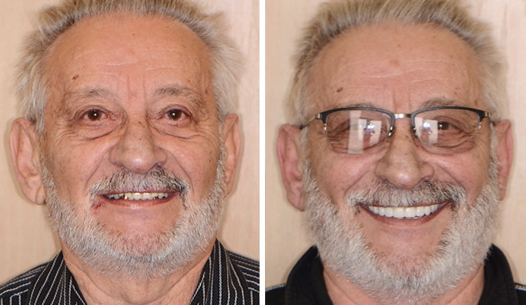 Full Mouth Restorations