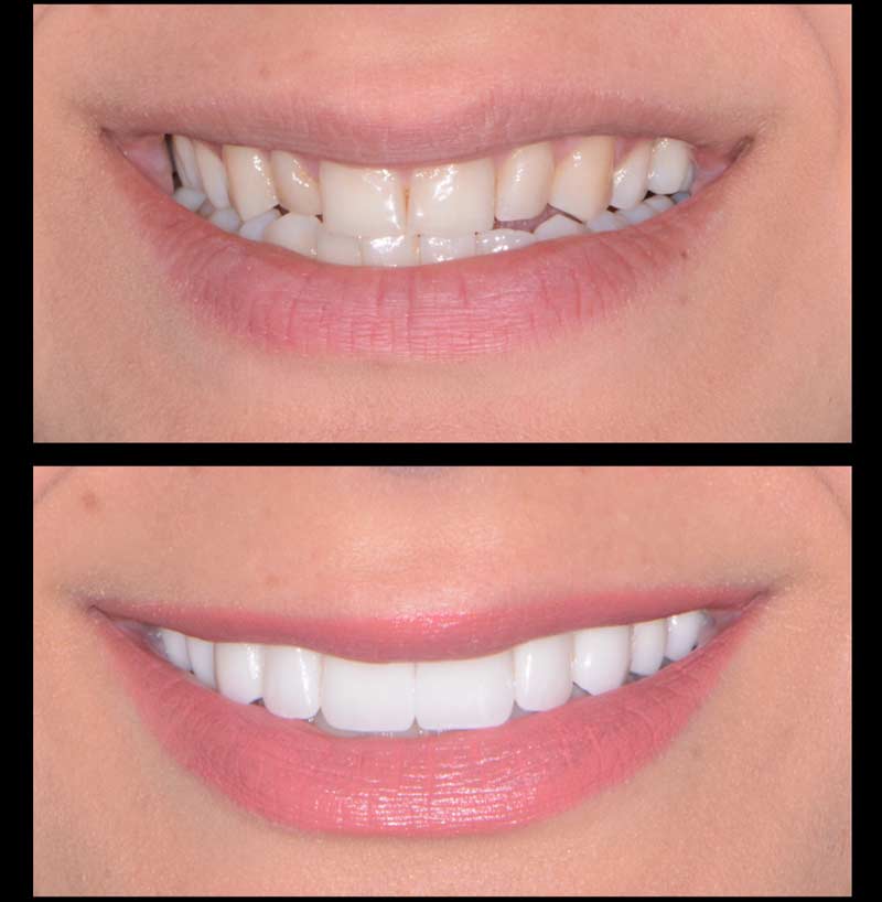 Get Lumineers Shelby Township Mi