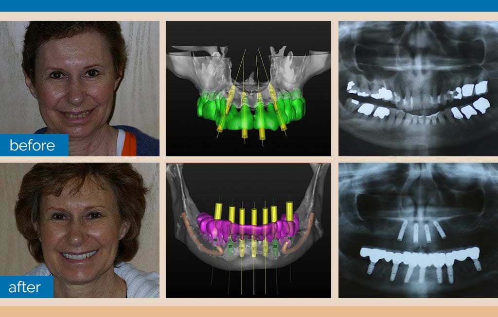 implant-dentist-in-shelby-township Dental Implants Dentist Shelby Township, MI