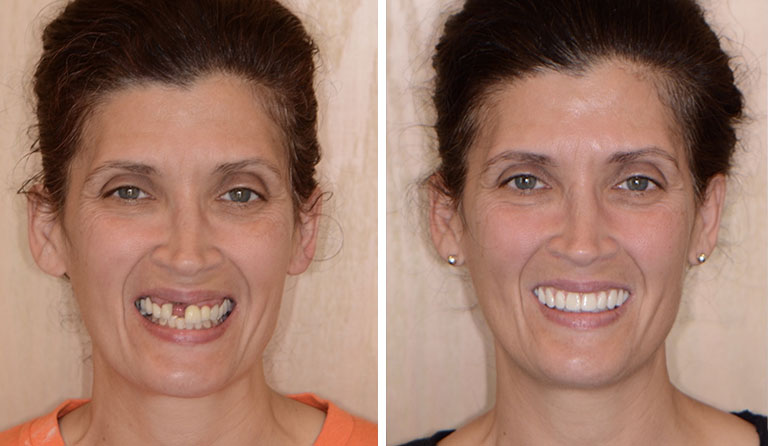 Veneers Dentist Near Me