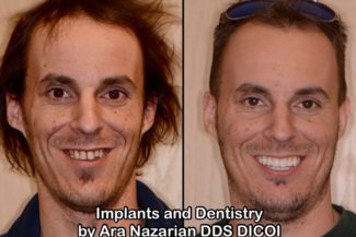 Same Day Implant Dentist Shelby Township Mi 325x217